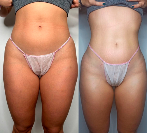 Resultados reales de Masaje Reductor con Maderoterapia en Barcelona - Beautygo Clinics